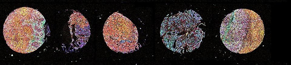 tissue microarray
