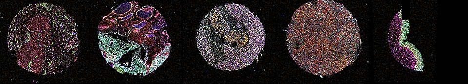 tissue microarray